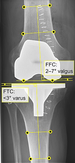 - FFC: frontal femoral component angle. It is typically regarded as optimal when being 2–7° in valgus.[63] - FTC: frontal tibial component angle, which is regarded as optimal when being at a right angle. A varus position of more than 3° has generally been found to increase the failure rate of the prosthesis.[63]