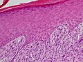 梭形细胞鳞状细胞癌