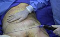 Fat removal using cannula during liposuction