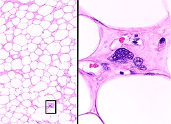 Histopathology of the major differential diagnosis of a well-differentiated liposarcoma, lipoma-like subtype: It looks almost identical at low magnification, but a high magnification of a fibrous band shows spindle cells with enlarged, hyperchromatic nuclei. H&E stain.