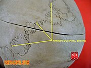 Wormian bones at lambdoid suture