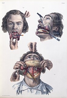 Illustrations of surgical removal of portions of the lower jawbone