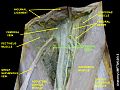 Femoral sheath