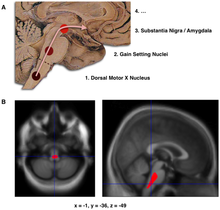 Composite of three images, one in top row (referred to in caption as A), two in second row (referred to as B). Top shows a mid-line sagittal plane of the brainstem andcerebellum. There are three circles superimposed along the brainstem and an arrow linking them from bottom to top and continuing upward and forward towards the frontal lobes of the brain. A line of text accompanies each circle: lower is "1. Dorsal Motor X Nucleus", middle is "2. Gain Setting Nuclei" and upper is "3. Substantia Nigra/Amygdala". A fourth line of text above the others says "4. ...". The two images at the bottom of the composite are magnetic resonance imaging (MRI) scans, one saggital and the other transverse, centred at the same brain coordinates (x=-1, y=-36, z=-49). A colored blob marking volume reduction covers most of the brainstem.