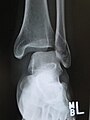 Fibular fracture with ankle joint widening.