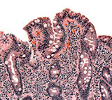 Biopsy of small bowel showing coeliac disease manifested by blunting of villi, crypt hyperplasia, and lymphocyte infiltration of crypts.