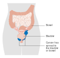 Stage 4A vaginal cancer