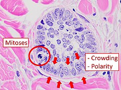 Cellular arrangement, including crowding and cell polarity (common tendencies among cells at the border, such as elongation or "palisading" in this case). Amount of mitoses can also be appreciated at this level.