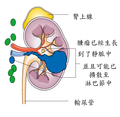 阶段3的肾癌