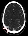 CT angiography showing an arachnoid granulation in the right transverse sinus