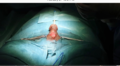 Penile Implant Surgery with minimal cut.