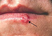 Cold sore on the lower lip (arrow)