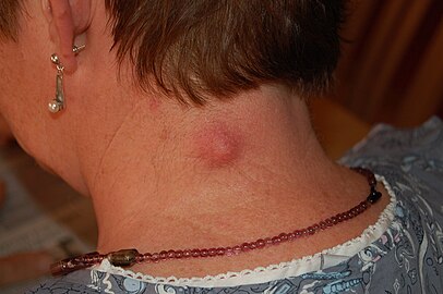 Inflamed epidermal inclusion cyst, nape of neck (Moved from Wikimedia Commons: Shared in Epidermal inclusion cyst)