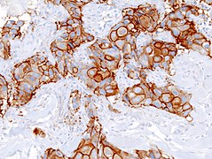 Immunohistochemistry of invasive ductal carcinoma of the breast representing a scirrhous growth. Core needle biopsy. HER-2/neu oncoprotein expression by Ventana immunostaining system.
