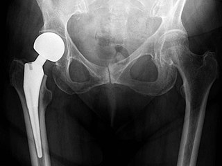 X-ray of the hips, with a right-sided hemiarthroplasty