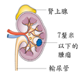 阶段1的肾癌