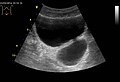 Diverticulum of the urinary bladder of a 59-year-old man, transverse plane