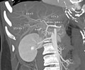 CT scan showing the liver and a kidney
