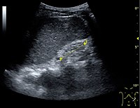 End-stage chronic kidney disease with increased echogenicity, homogenous architecture without visible differentiation between parenchyma and renal sinus and reduced kidney size. Measurement of kidney length on the US image is illustrated by '+' and a dashed line.[55]