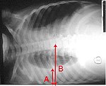 Pleural effusion