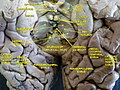 Cerebrum. Inferior view. Deep dissection