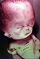 Young children with hydrocephalus typically have an abnormally large head, as fluid pressure causes individual skull bones to bulge outward.
