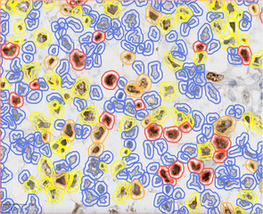 Ki67 stain calculation by QuPath in a pure seminoma, which gives a measure of the proliferation rate of the tumor. The colors represent the intensity of expression: blue-no expression, yellow-low, orange-moderate, and red-high expression.[14]