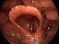 Structures of the larynx as viewed during laryngoscopy. The leaf-like epiglottis is shown as number '3'. Other structures: 1=vocal folds, 2=vestibular fold, 3=epiglottis, 4=plica aryepiglottica, 5=arytenoid cartilage, 6=sinus piriformis, 7=dorsum of the tongue