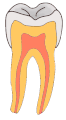 Smooth Surface Caries GIF