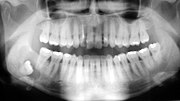 Cyst on a wisdom tooth