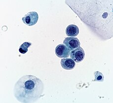 High-grade urothelial carcinoma. A cytologic diagnosis of high-grade urothelial carcinoma requires > 10 cells with high N/C ratio, irregular chromatin pattern and hyperchromatic nuclei (Pap stain).[5]