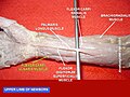 Flexor carpi ulnaris muscle