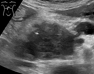 The cancer in the pancreatic head is seen as hypoechoic, and has grown to 4.5 cm. A dilated pancreatic duct is seen to the right of it.