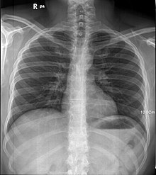 人体肺部的X射线影像