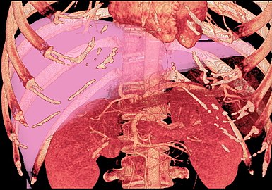 MDCT image. 3D image created by MDCT can clearly visualize the liver, measure the liver volume, and plan the dissection plane to facilitate the liver transplantation procedure.