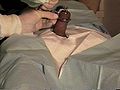 File:My_gomco_circ_may96.jpg -- A 22-year-old Canadian man being circumcised with a Gomco clamp.