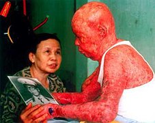 Major Tự Đức Phang was exposed to dioxin-contaminated Agent Orange.
