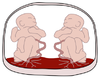 Monochorionic monoamniotic twins